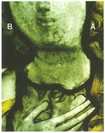 Fig. 33. (A) Mechanically cleaned half of the face. (B) Uncleaned half
                            of face.